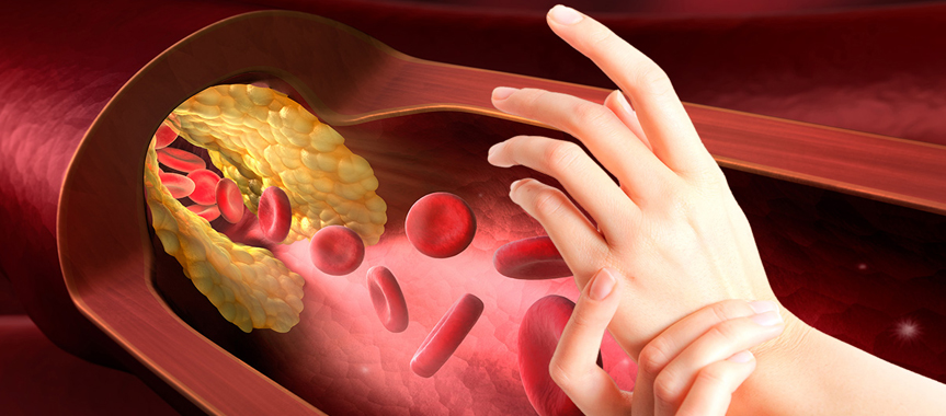 Повышенный холестерин